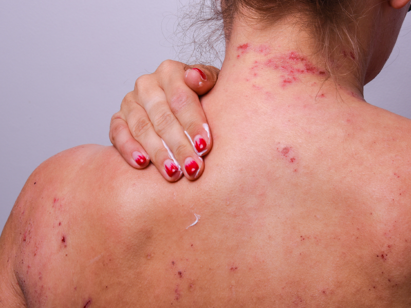Beyond basics in atopic dermatitis patient perspective