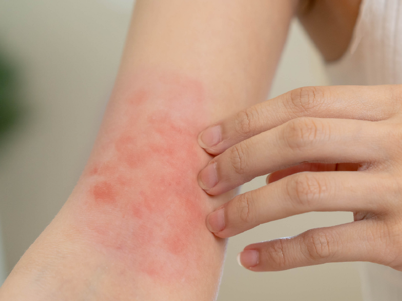 Atopic Dermatitis Across the Lifespan Webcast