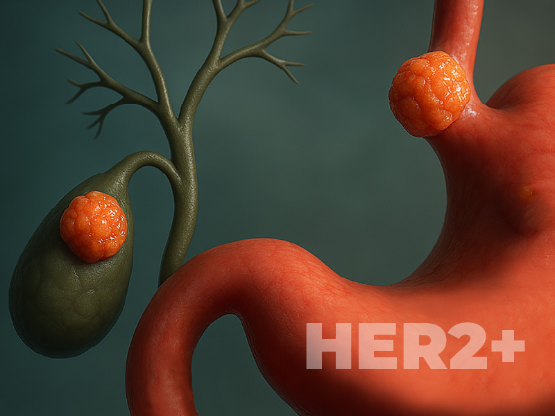 Management of HER2pos GEA