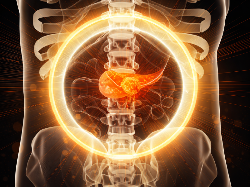 Pancreatic Cancer ASCO Forum