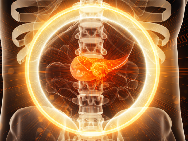 Innovations in Pancreatic Cancer