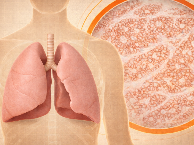HER2 Overexpression NSCLC Case